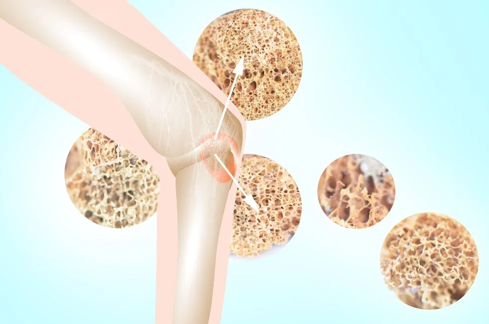Bone Health And Reduced Risk Of Osteoporosis