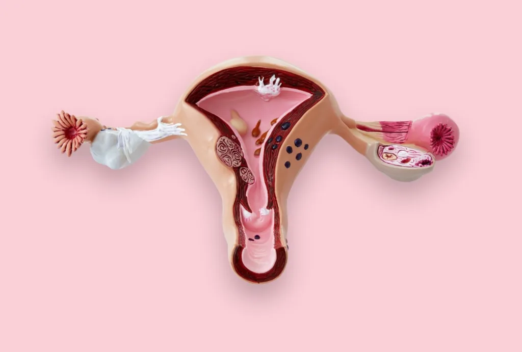 Polycystic Ovary Syndrome and Electrolysis